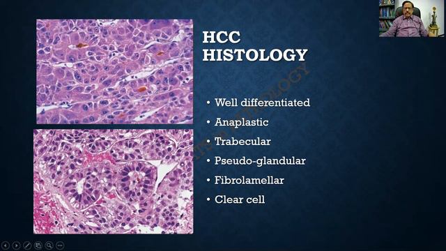 Carcinoma Liver - R.A.T.S in Pathology смотреть онлайн