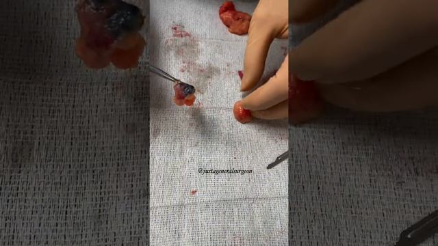 Inside the OR with @justageneralsurgeon - breast cancer surgery and sentinel lymph node biopsy смотреть онлайн