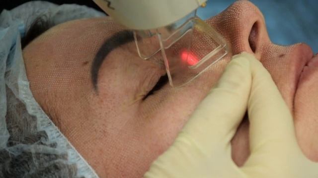 Лазерный пилинг (шлифовка) фракционным CO2 лазером