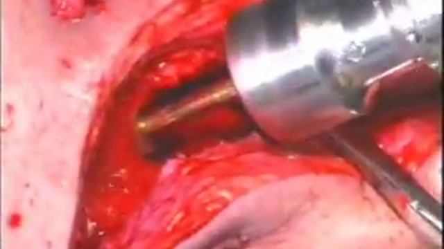 Остеомиелит большеберцовой кости osteomielit tibula смотреть онлайн