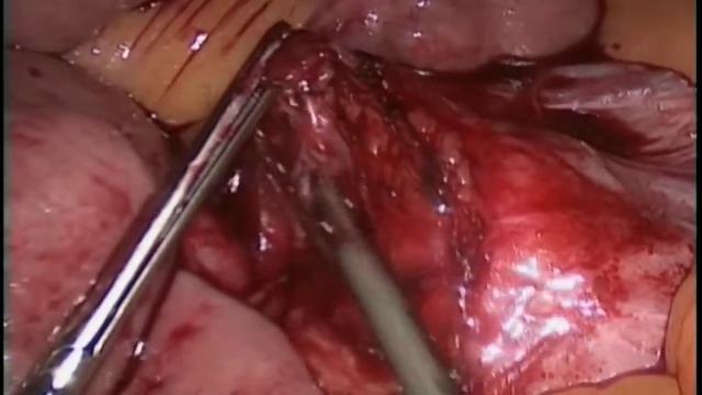 14 382GS Laparoscopic Resection of Retroperitoneal Paraaortic Colorectal Metastasis смотреть онлайн