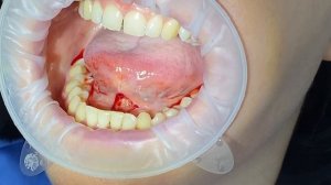 Пластика уздечки языка? Зачем это нужно?#клиникамосква #стоматология #хирургия