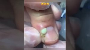 ГНОЙ С ПАЛЬЦА