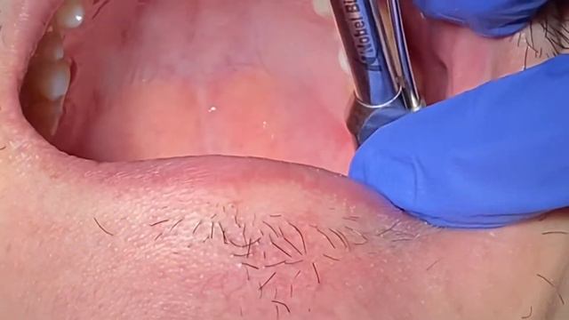 How to deliver the screwed retained implant crown смотреть онлайн