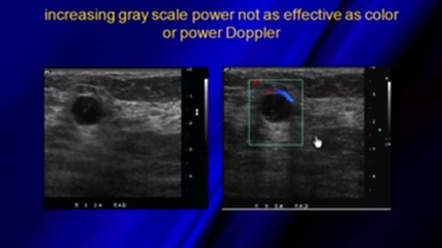 Non Simple Cysts and Color Doppler in Breast Sonography смотреть онлайн