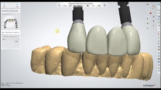 DDA Моделирование временного моста на имплантатах в 3Shape Dental System смотреть онлайн