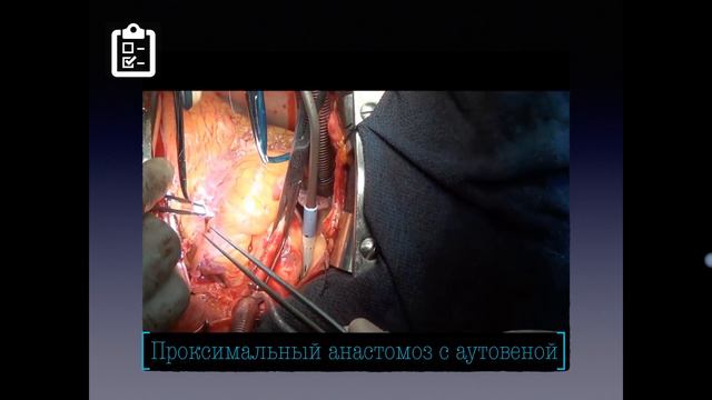 ИБС-2 смотреть онлайн