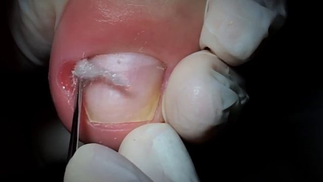 ESPÍCULA, PUS, ESPÍCULA E MAIS PUS. смотреть онлайн