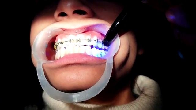 Braces Treatment by Dr. Yuvraj Bhardwaj part 1 смотреть онлайн