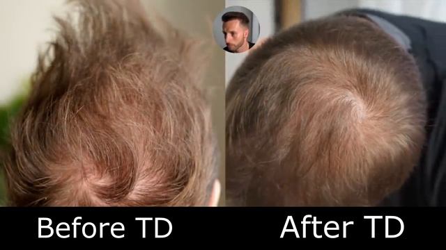 TOPICAL DUTASTERIDE UPDATE! 2021 смотреть онлайн