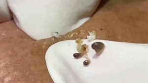 ОГРОМНЫЕ прыщи и ЧЁРНЫЕ точки | РЕЛАКС видео | Выдавливание ЧЁРНЫХ точек