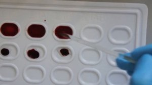 Определения групп крови с помощью цоликлонов