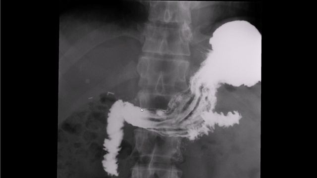 Скопия желудка с барием, хронический гастрит смотреть онлайн