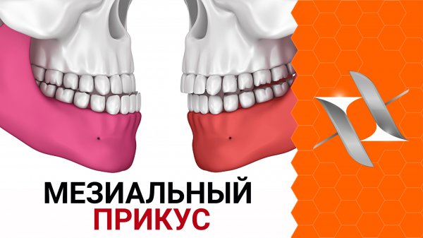 МЕЗИАЛЬНЫЙ прикус. Причины. Последствия. Лечение.