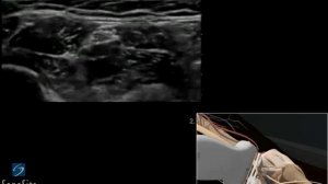 3D-пособие: Блокада седалищного нерва в подколенной ямке под контролем ультразвука