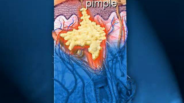 acne.flv смотреть онлайн