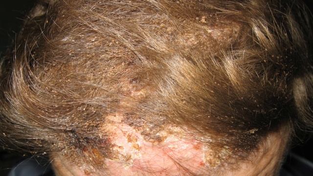 Как избавиться от вшей в домашних условиях? смотреть онлайн