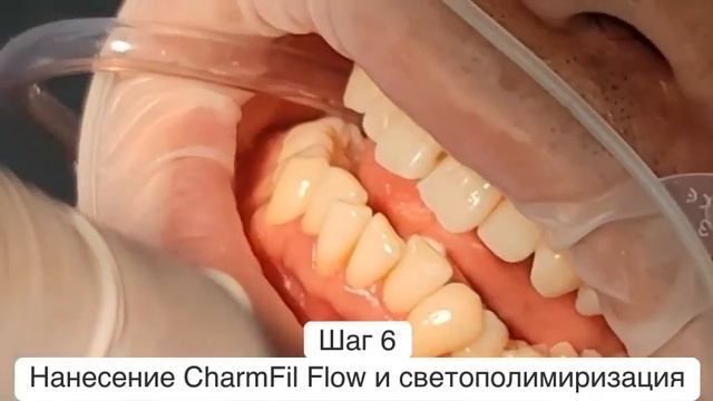 Новинка! Жидкотекучий светоотверждаемый материал для зубов Charmfil flow (Чамфил флоу). смотреть онлайн