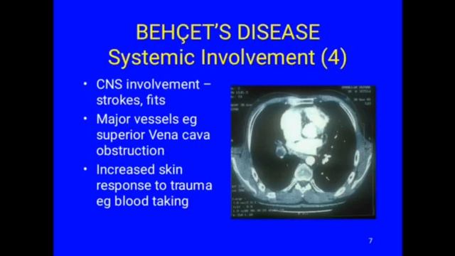Behcets disease. смотреть онлайн
