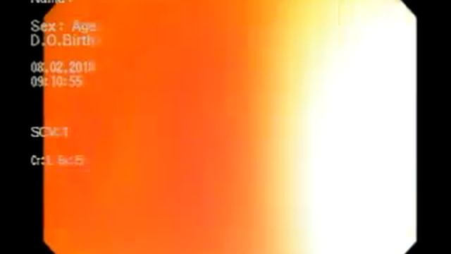 Опухоль толстого кишечника 2018 08 02 смотреть онлайн