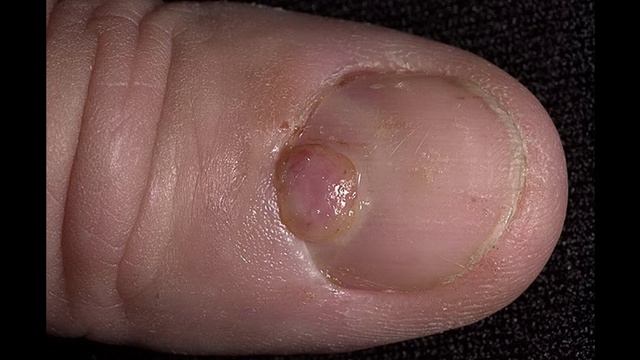 Что нужно знать о подногтевой меланоме?﻿ (подкаст) смотреть онлайн