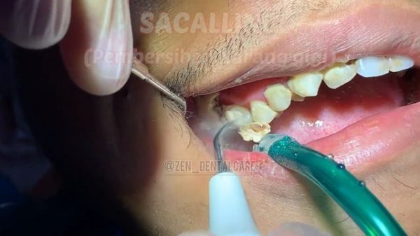 Pembersihan Karang Gigi (SCALLING)- DOKTER GIGI