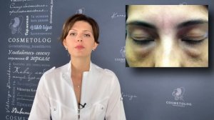 ОСЛОЖНЕНИЯ После ФИЛЛЕРОВ?? ЧТО НЕЛЬЗЯ ДЕЛАТЬ После ФИЛЛЕРОВ ❗️❗️❗️ чтобы  Предотвратить Осложнения
