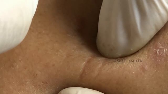 Suri Job 11: ATTACK ACNE ON CHEEK BY HAND | GREAT POPS смотреть онлайн
