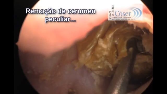 Удаление гигантского куска серы из уха | Гигантская серная пробка смотреть онлайн