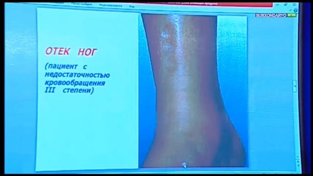 PATOFIZ LEKSIYA SUV ALMASHINUVI BUZILISHI SHISHLAR Патофизиология водноэлектролитного обмена и ОТЕК