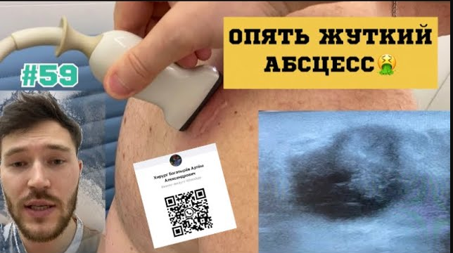 59. ШОК, гнойник! Опять РЕЗАТЬ!