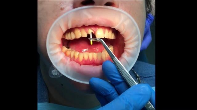 Восстановление полностью разрушенного зуба с помощью культевой вкладки и коронки из циркония