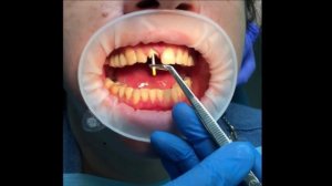 Восстановление полностью разрушенного зуба с помощью культевой вкладки и коронки из циркония