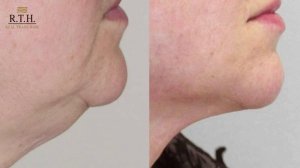 Платизмопластика и подтяжка подбородка.