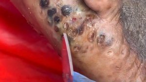 John’s part B of left foot - SO MANY JIGGERS - see full video @riseupsociety.net