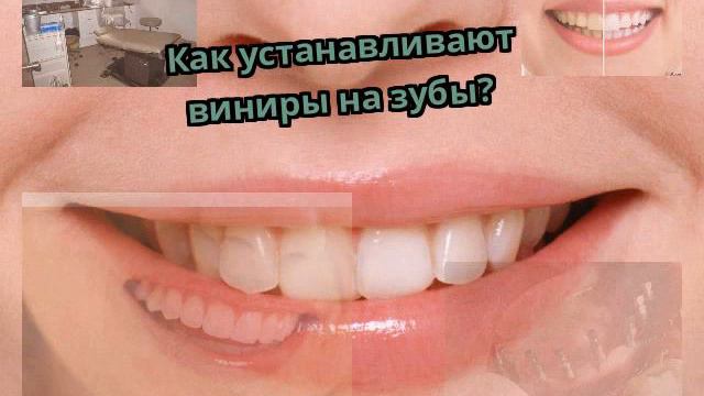 Как устанавливают виниры на зубы? смотреть онлайн