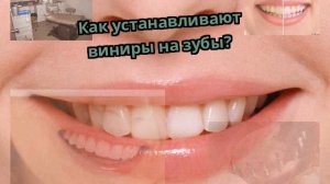 Как устанавливают виниры на зубы?