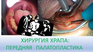 ХИРУРГИЯ ХРАПА: Передняя палатопластика. ЛОР-врач к.м.н. Фуки Евгений Михайлович о лечении храпа