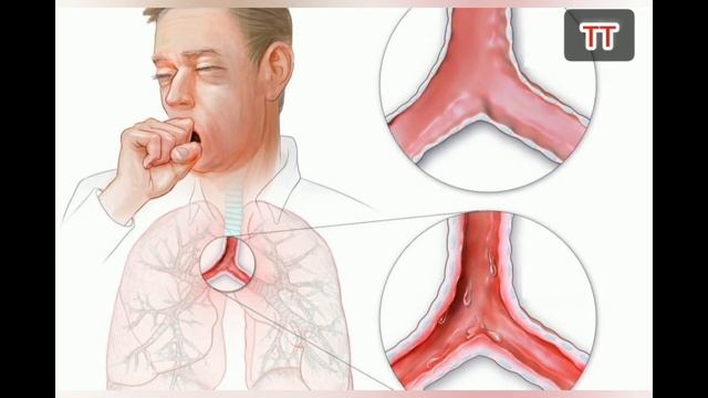 BRONXIT KASALLIGI VA UNING PROFILAKTIKASI