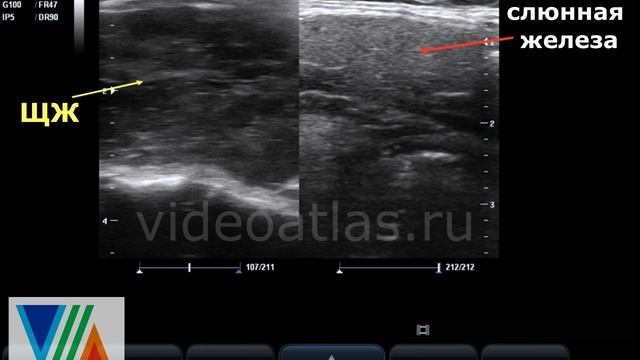 Диффузные изменения щитовидной железы смотреть онлайн