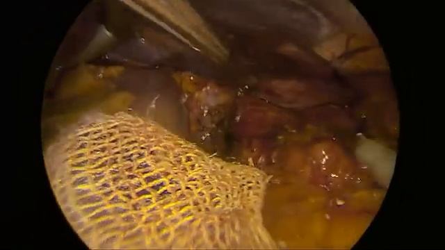 Грыжа пищеводного отверстия диафрагмы. Лапароскопическая крурорафия, фундопликация по Ниссену. смотреть онлайн