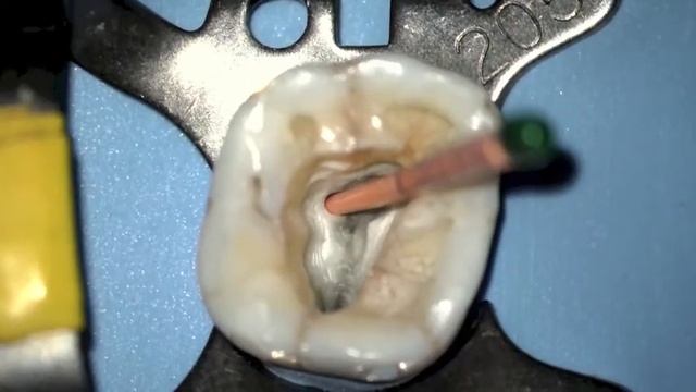 Nevadent prezentuje: FKG TotalFill BC Sealer 2 смотреть онлайн