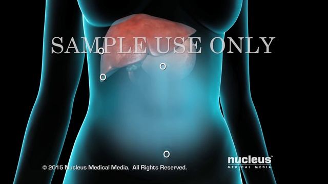 Cholecystectomy | Gallbladder Removal Surgery | Nucleus Health смотреть онлайн