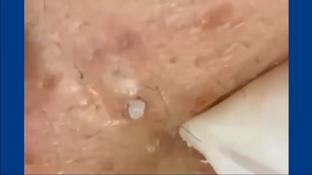 Удаление черных точек 2021-15a/ blackheads acne big смотреть онлайн