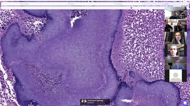 Actinomyces (Actinomycotic Mycetoma) with Splendore-Hoeppli phenomenon: 5-Minute Pathology Pearls смотреть онлайн