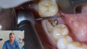 Удаление зуба. Часть 2. Жевательный отдел.