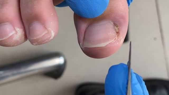 Ingrown Nails At The Base Of The Toenails, Causing The Patient To Walk Painfully【Xue Yidao】
