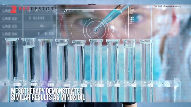 *OUCH!* But it WORKS?? Mesotherapy for Hair Loss - Side Effects & Review of Study (Before & After) смотреть онлайн