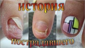 История ПОСТРАДАВШЕГО ногтя /ПРОТЕЗИРОВАНИЕ