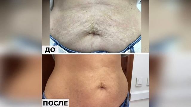 Результаты лечения растяжек смотреть онлайн